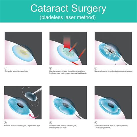 cataract surgery in huddersfield|Overview .